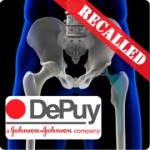 DePuy Hip Replacement Recall Injury Attorneys